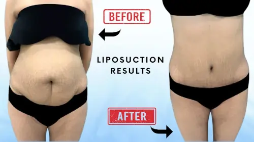 Liposuction before after results